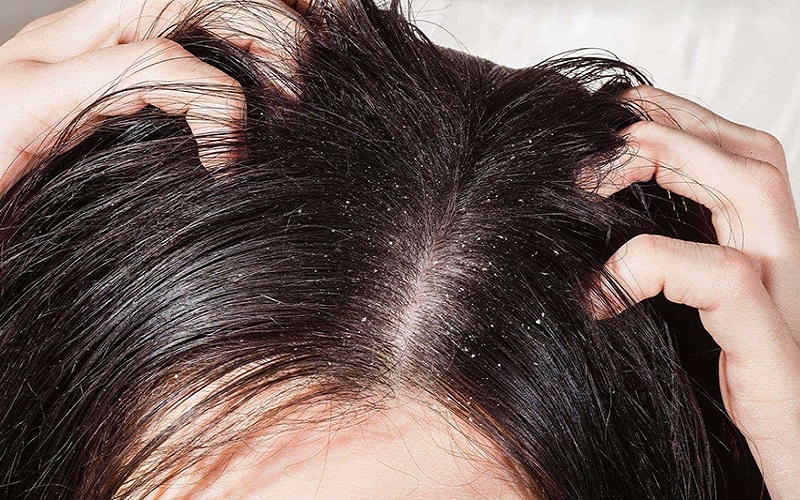 Ngoài nuôi dưỡng tóc gội đầu thảo dược còn cải thiện các vấn đề da dầu